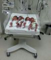 ولادة ناجحة لأم حامل بـ 4 توائم  بمستشفى الملك عبد العزيز بجدة