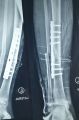 مستشفى الدلم ينجح في إنقاذ ساق متفتتة لشاب مع كسر مضاعف.